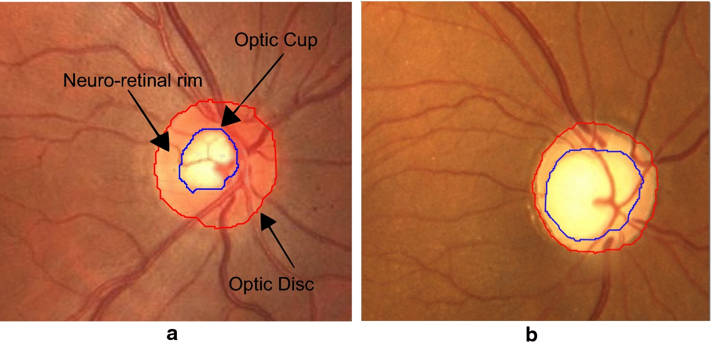 CNNs for automatic assessment using fundus images an