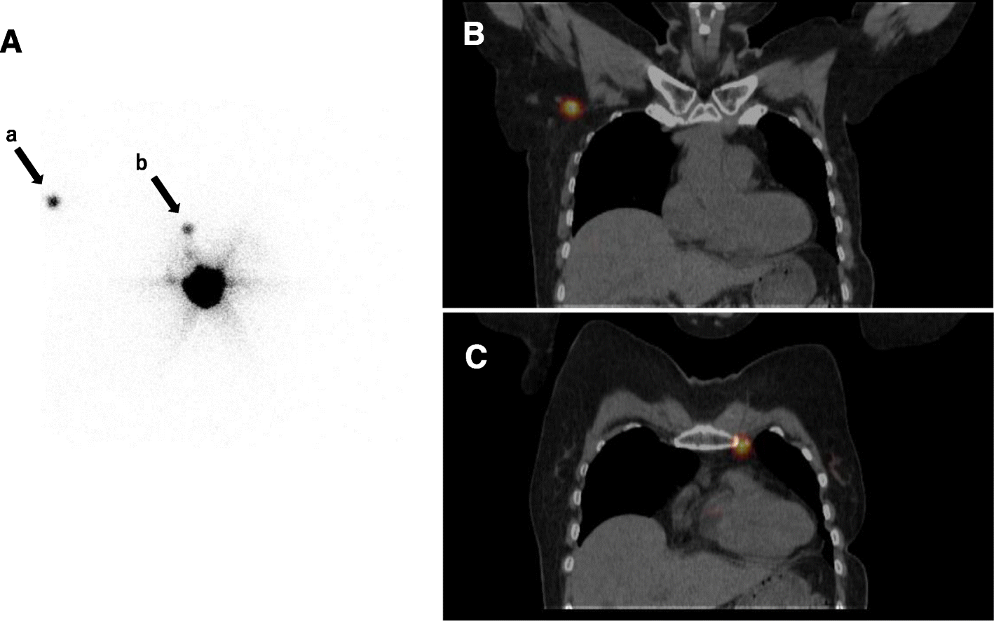 breast ectomy with sentinel node biopsy breast ectomy with sentinel node biopsy