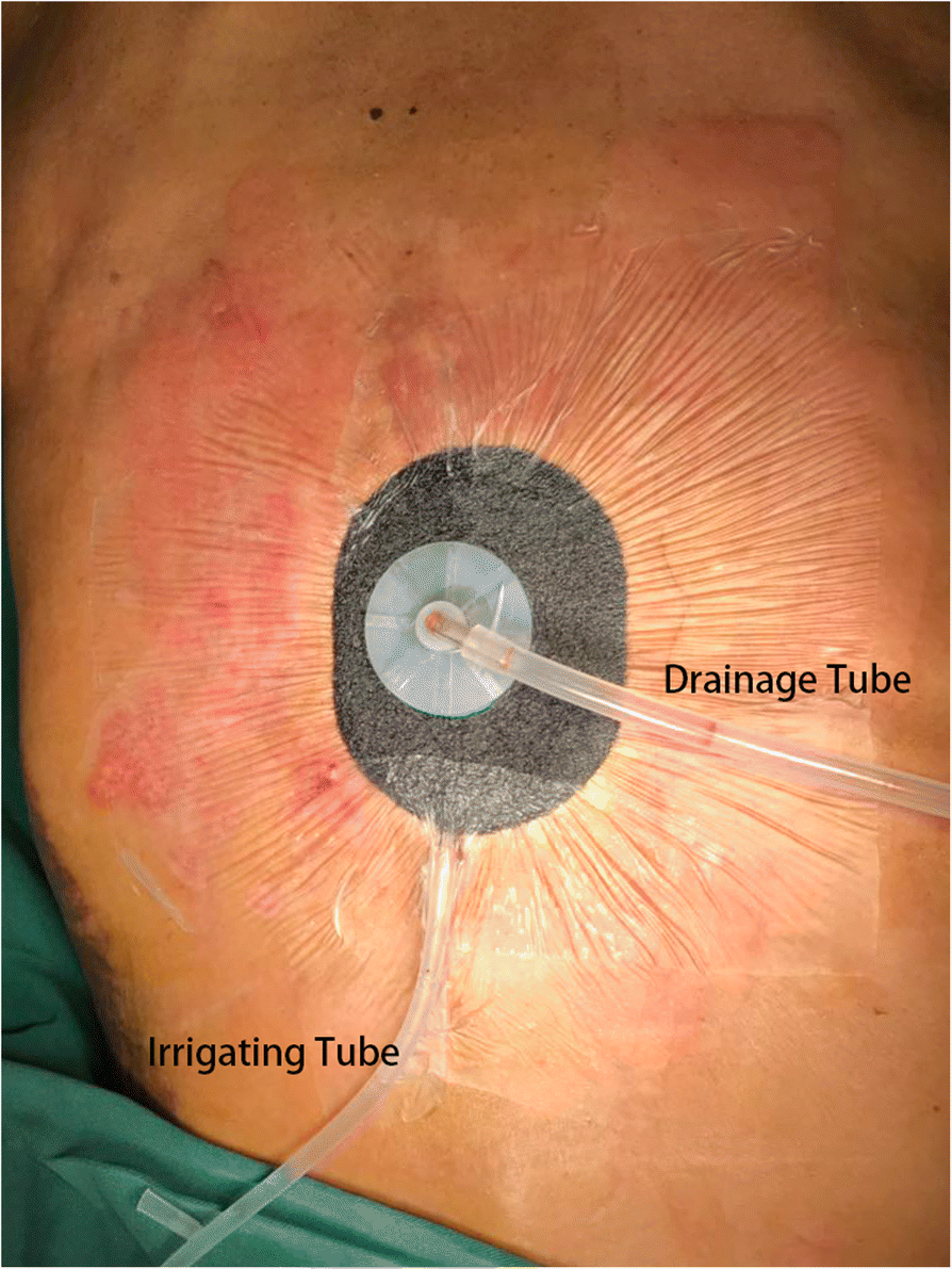 Vacuumassisted closure combined with a closed suction irrigation