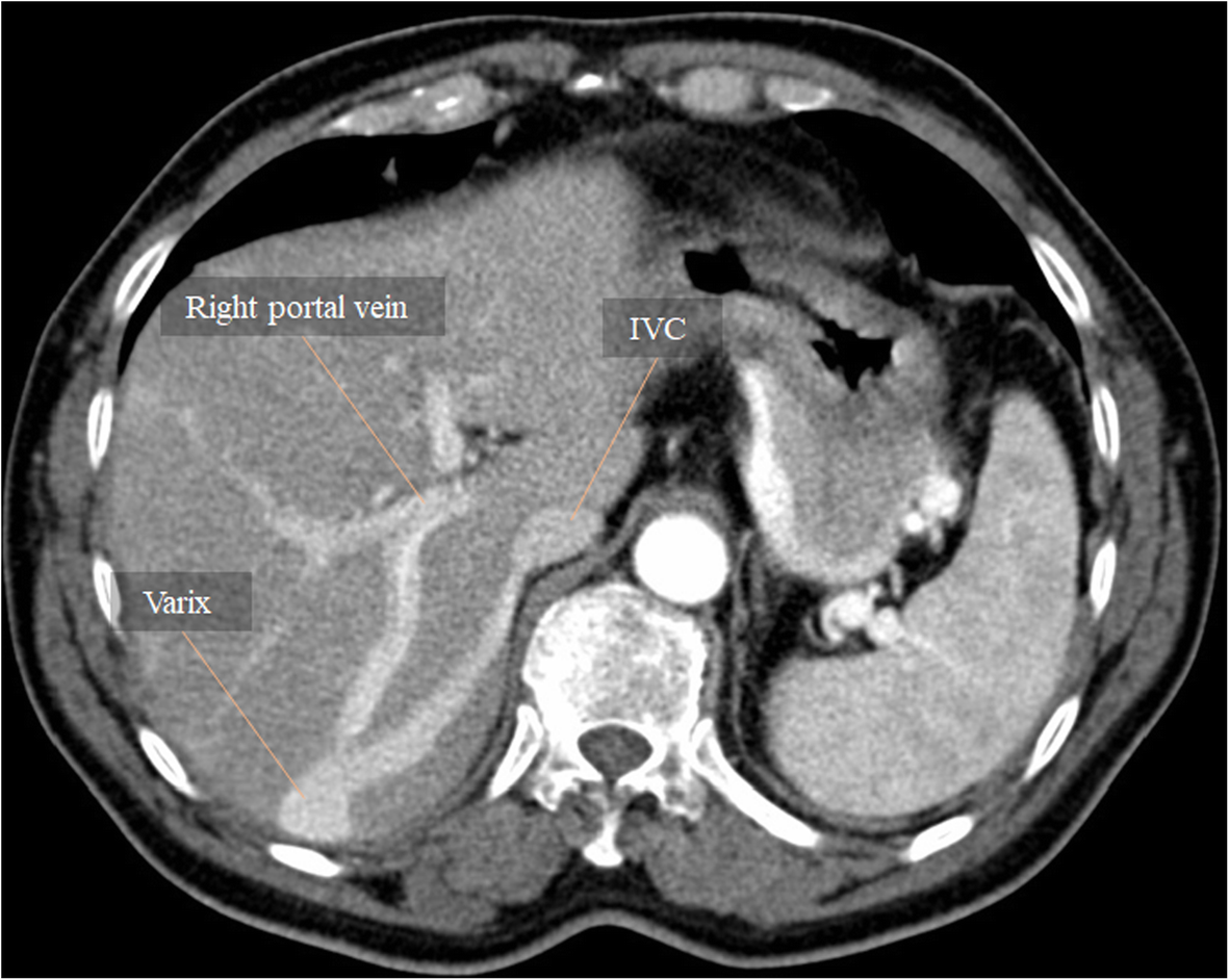 All about portal vein: a pictorial display to anatomy, variants and ...