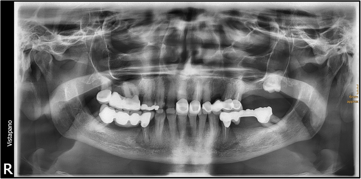Lymph node abscess caused by Francisella tularensis a rare