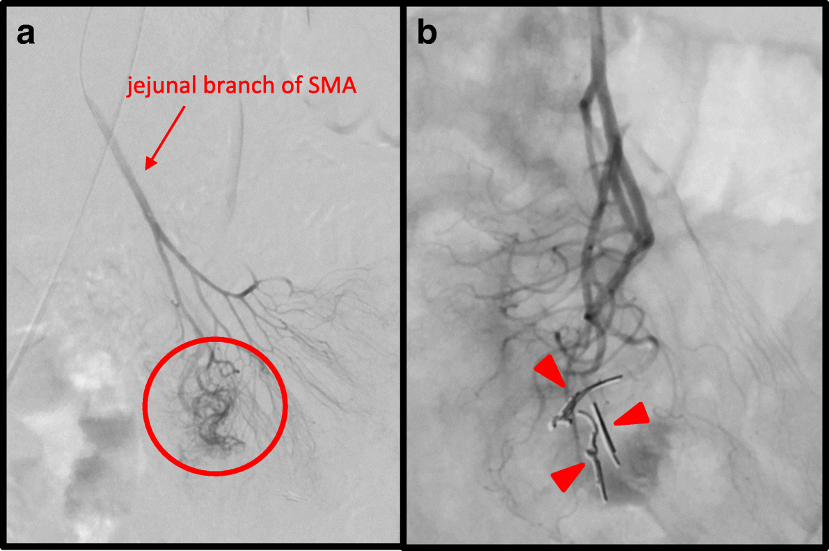 Laparoscopic resection of idiopathic jejunal arteriovenous malformation after metallic coil