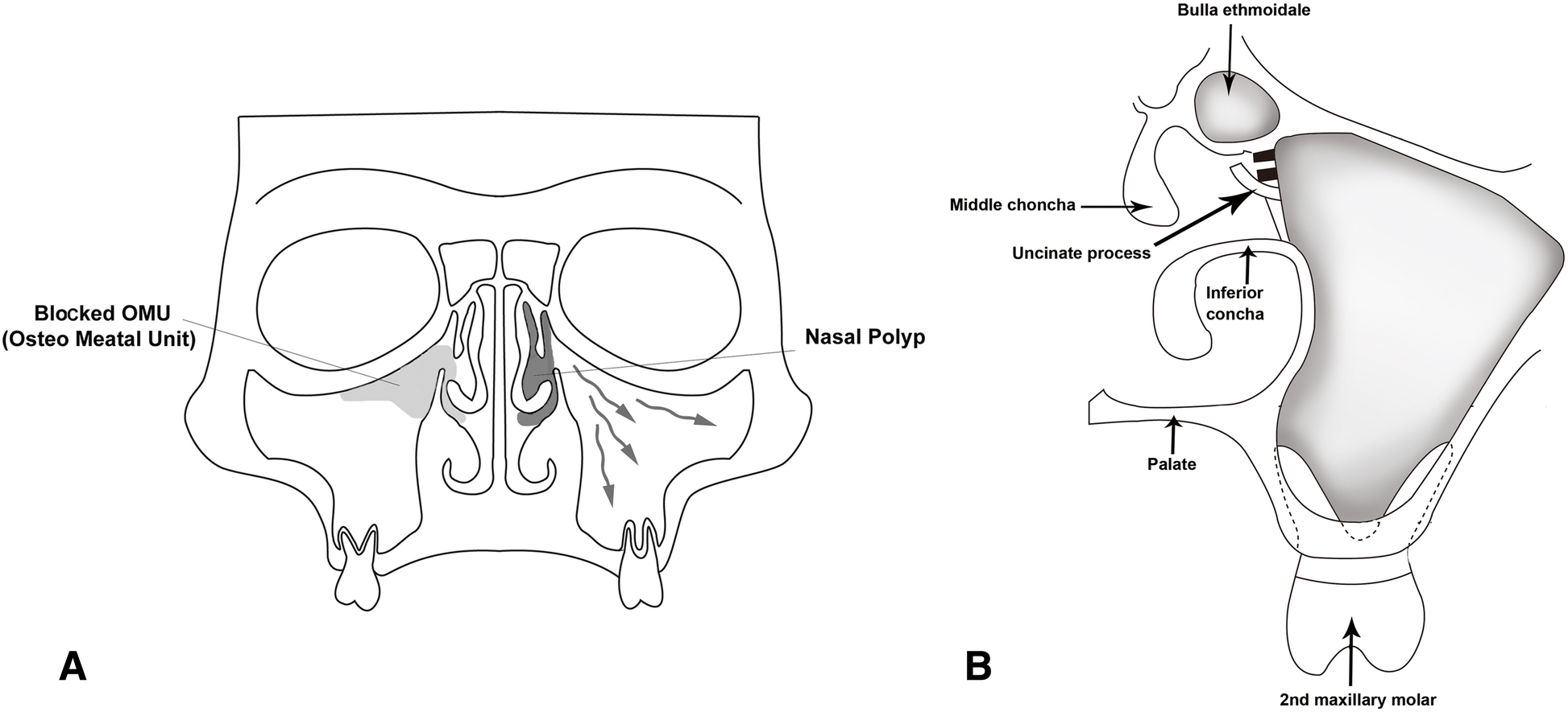 Sinusitis Definition Of Sinusitis By Medical Dictionary