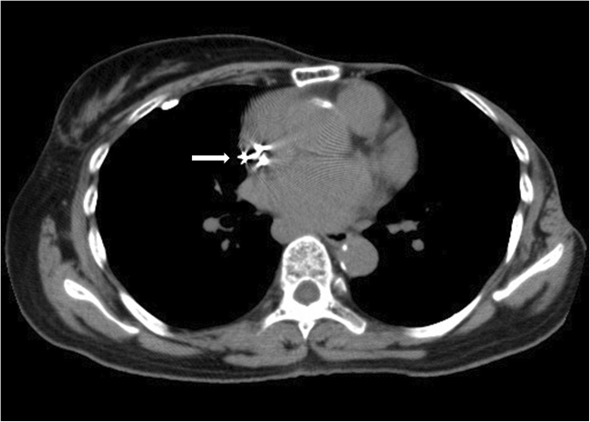 Sudden onset pacemakerinduced diaphragmatic twitching during general