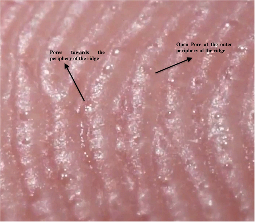 A comparative study of characteristic features of sweat pores of finger