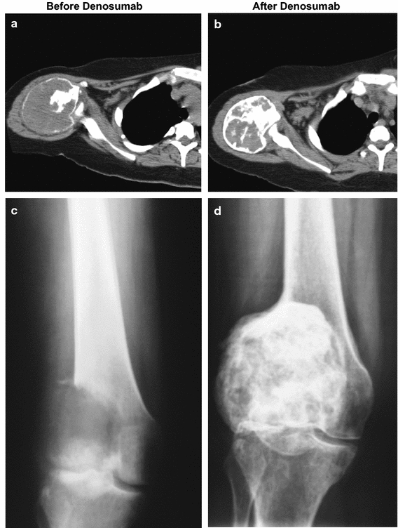 Surgical Downstaging in an Open-Label Phase II Trial of Denosumab in ...