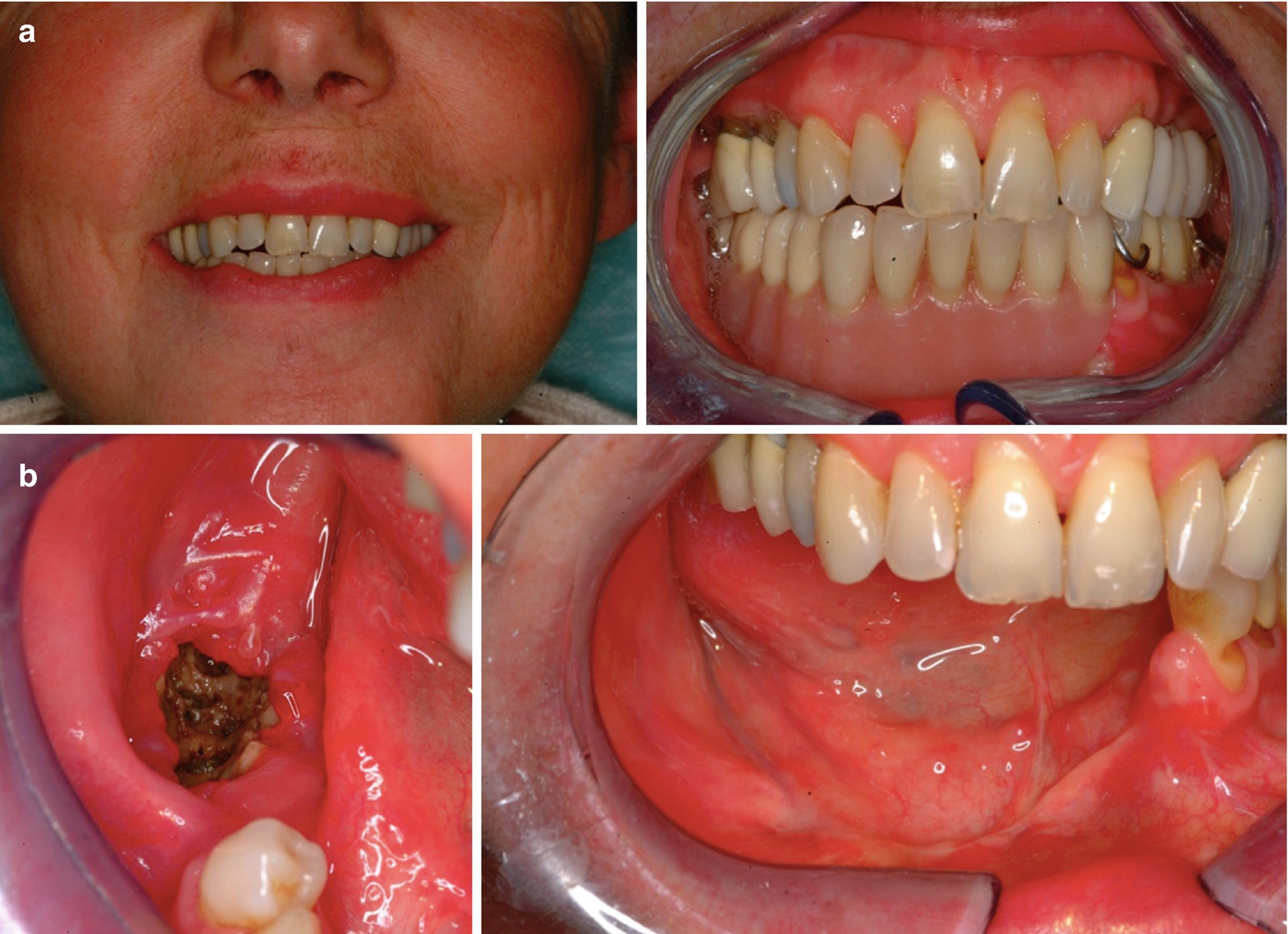 Reconstructive Surgery Following Bisphosphonate Related Osteonecrosis Of The Jaws Evolving Concepts Springerlink