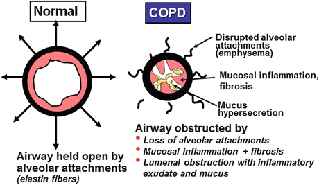 Pathogenesis Of Copd And Asthma Springerlink