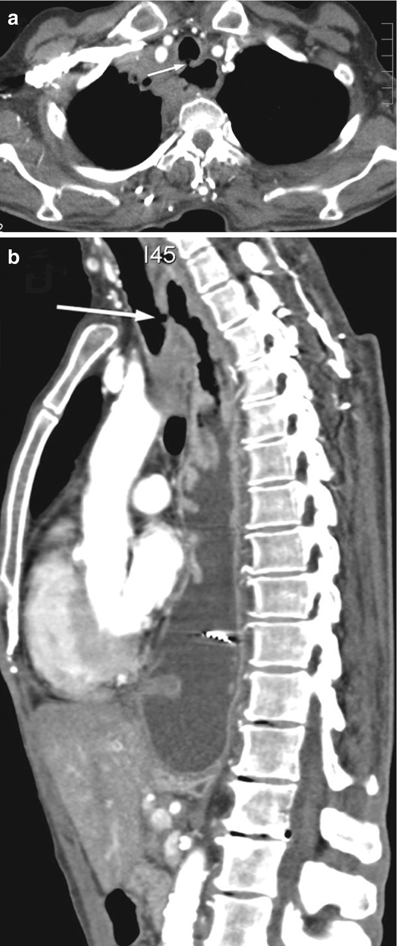 Cross Sectional Imaging Of The Oesophagus Using Ct And Pet Techniques Springerlink