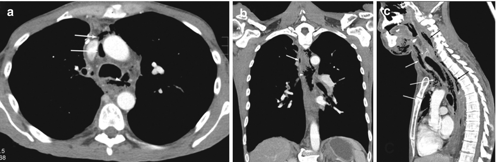 Cross Sectional Imaging Of The Oesophagus Using Ct And Pet Techniques Springerlink