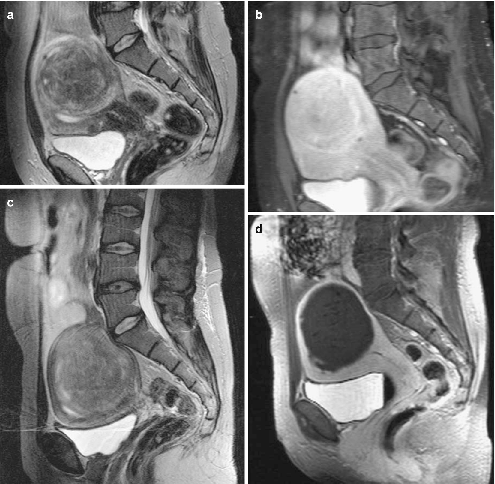 Benign Uterine Lesions Springerlink