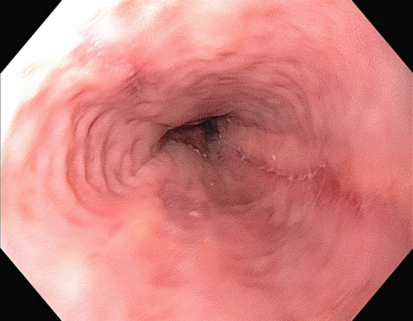 Surgery In Benign Oesophageal Disease Springerlink - 