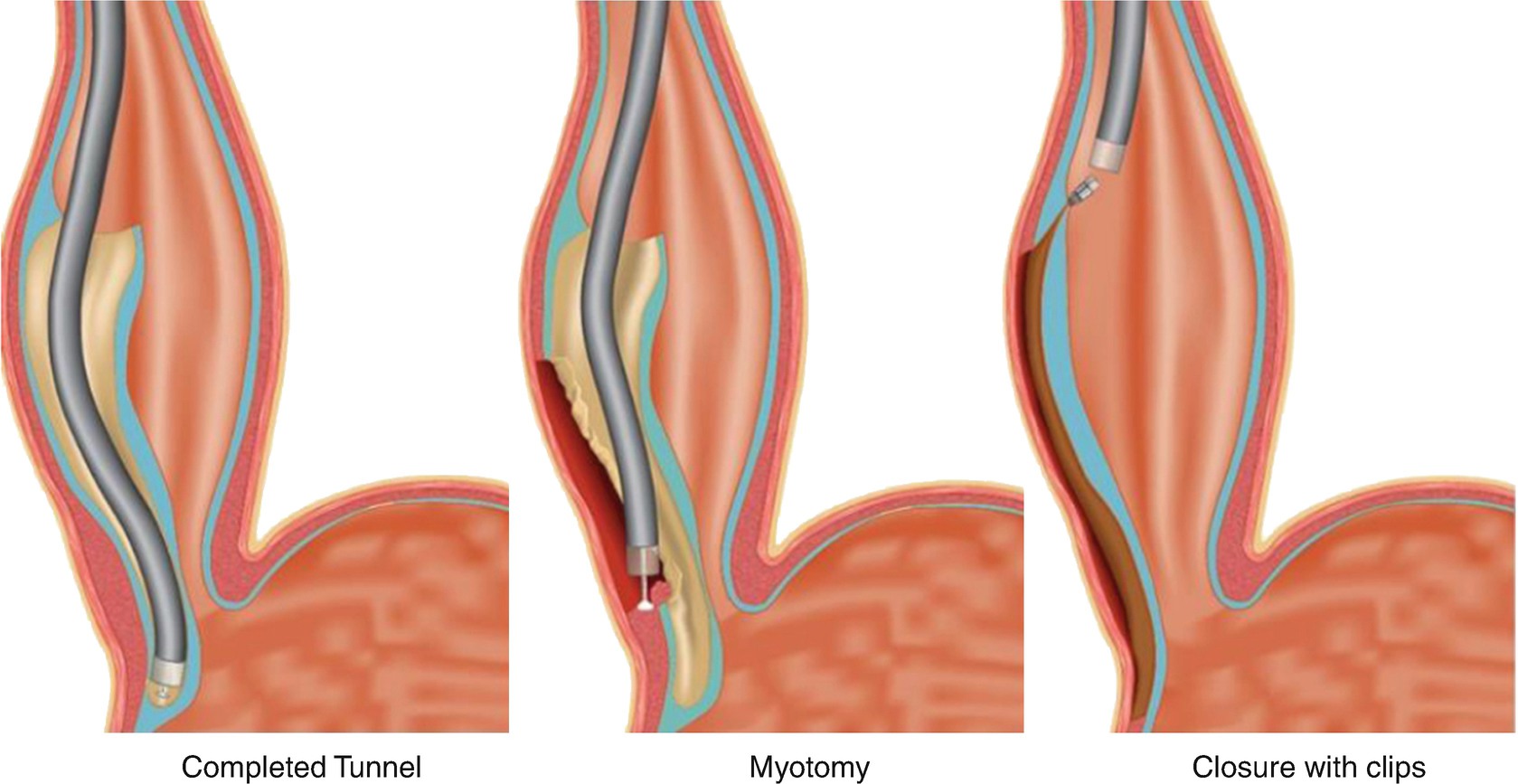 Surgery In Benign Oesophageal Disease Springerlink - 