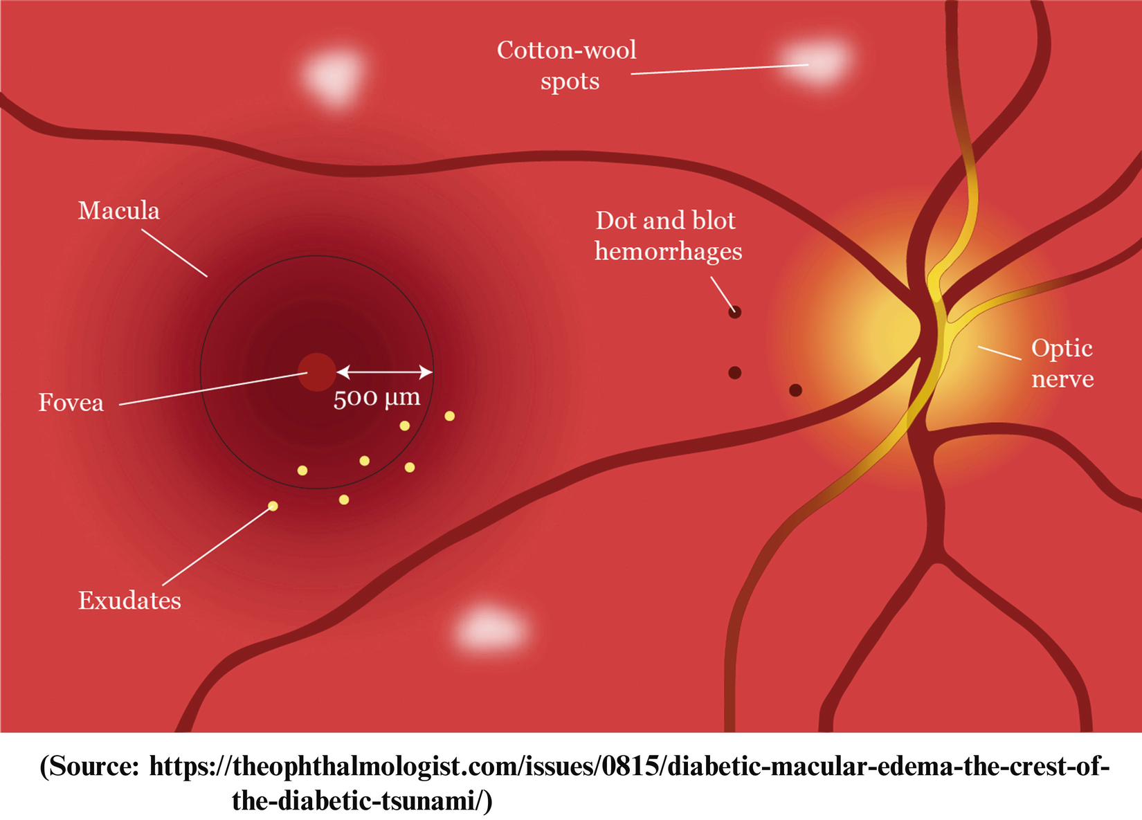 Retinal edema definition.