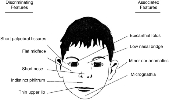 Fetal Alcohol Syndrome Springerlink