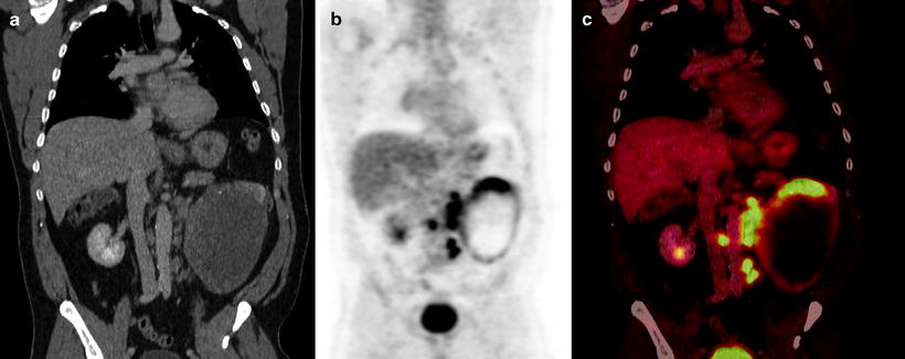 PET-CT of Renal Cell Carcinoma | SpringerLink