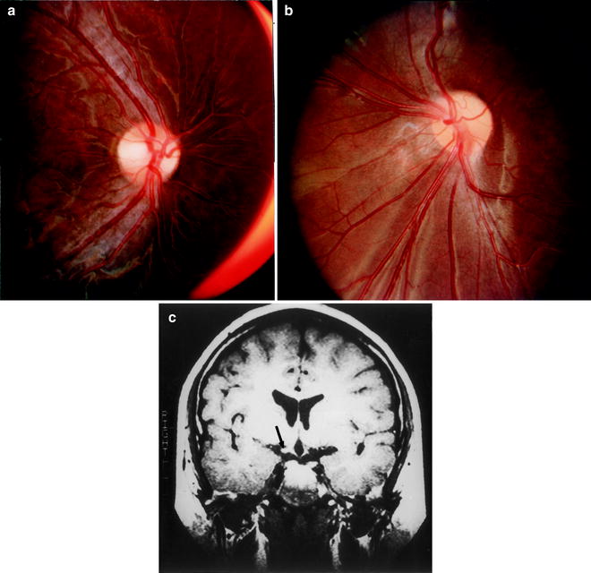 Optic Atrophy In Children Springerlink - 