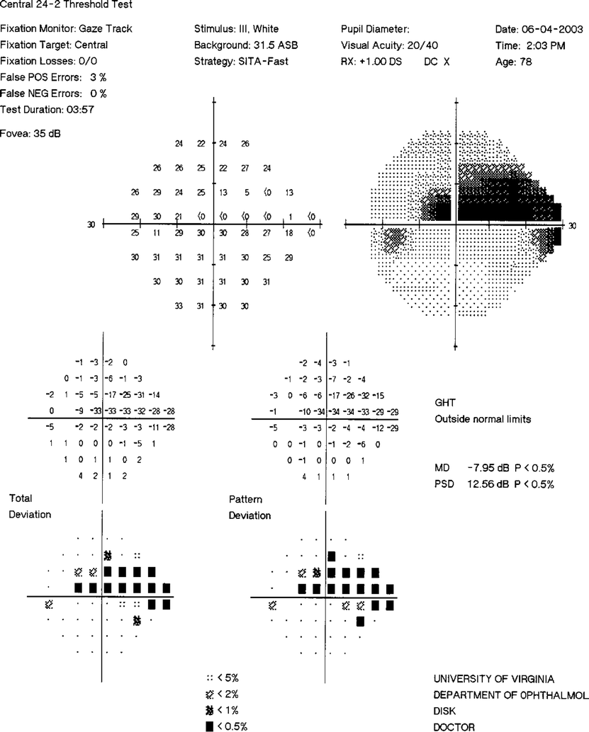 Normal Pressure Glaucoma Springerlink