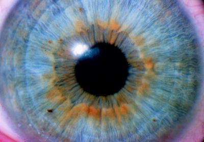 Figure 5 From Fuchs Heterochromic Uveitis A Reappraisal Of The