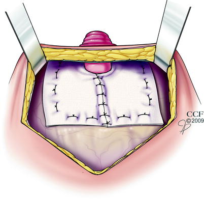 Parastomal Hernia | SpringerLink