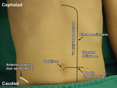 Rectus Sheath and Transversus Abdominis Plane (TAP) Blocks | SpringerLink