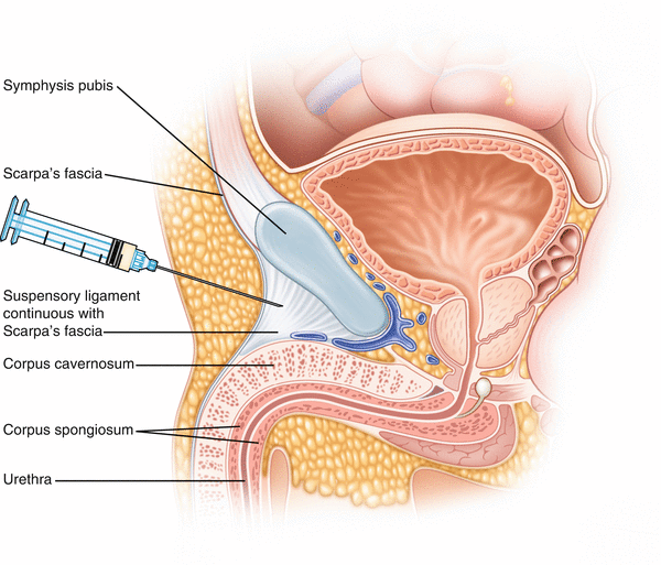 Penile Blocks Springerlink