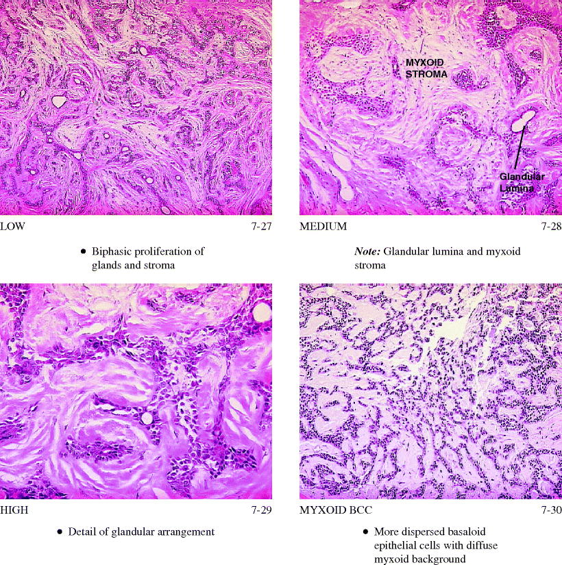 Basal Cell Carcinoma Variants And Challenges Springerlink