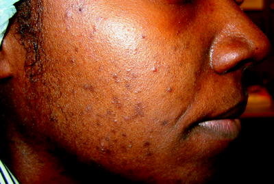 triamcinolone cream for rosacea