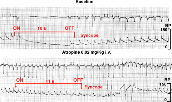 How to: Carotid Sinus Massage | SpringerLink
