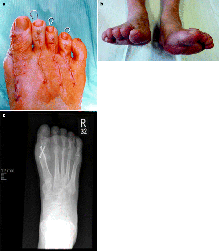 Surgical Treatment of Hammer Toe, Claw Toe, and Mallet Toe Deformity