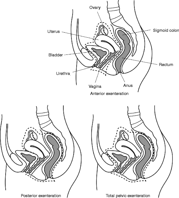 pelvic exenteration specimens springerlink