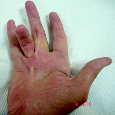 Examination of the Wrist and Hand