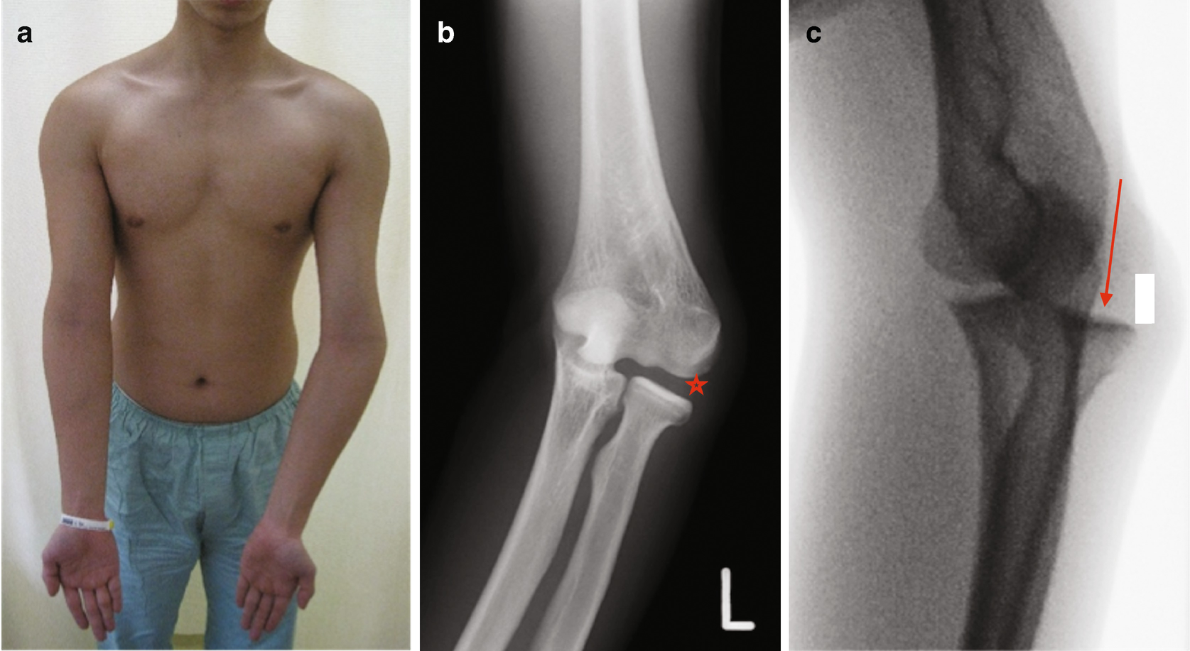 malunion distal humerus)