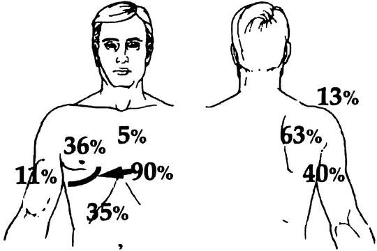 45+ Post thoracotomy pain syndrome
