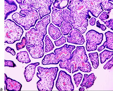 mullerian papilloma emberi papillomavírus emberben