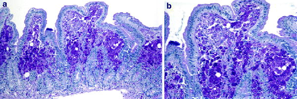 Whipple's Disease | SpringerLink