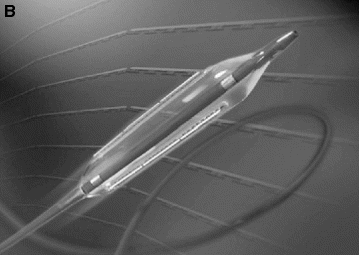 angioplasty ultra balloon