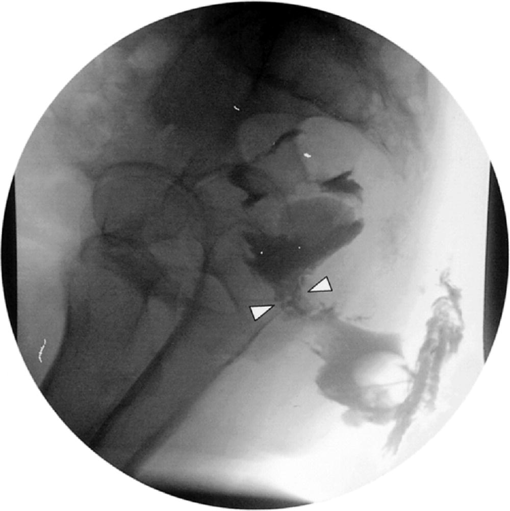 Anorectal Abscess And Fistula Springerlink