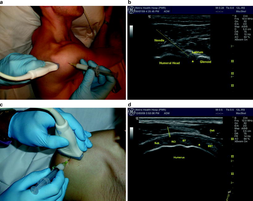 UltrasoundGuided Shoulder Joint and Bursa Injections SpringerLink