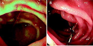 Management of Dieulafoy’s Lesions | SpringerLink