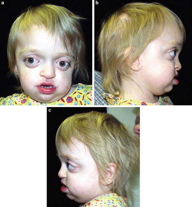 of Common Congenital Syndromes of the Head and Neck SpringerLink