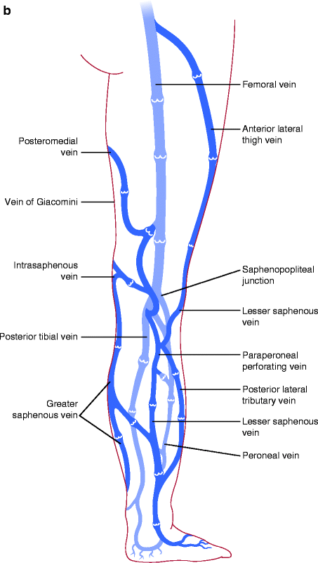 Lower Extremity Venous Ablation and Sclerotherapy | SpringerLink