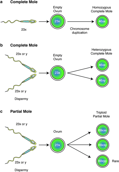 Hydatidiform Moles | SpringerLink