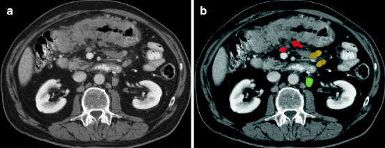 Abdominal Lymph Node Anatomy | SpringerLink