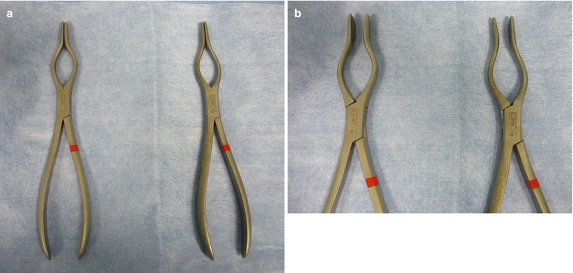 Nasal Fractures Springerlink