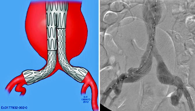 Pelvic Revascularization During Endovascular Aortic Aneurysm Repair Springerlink