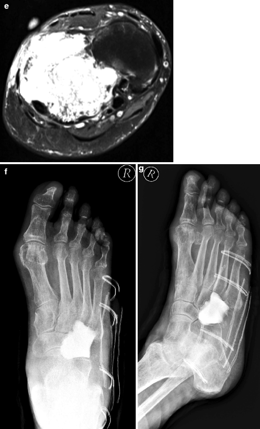 Tumors and TumorLike Lesions of the Foot and Ankle Diagnosis and
