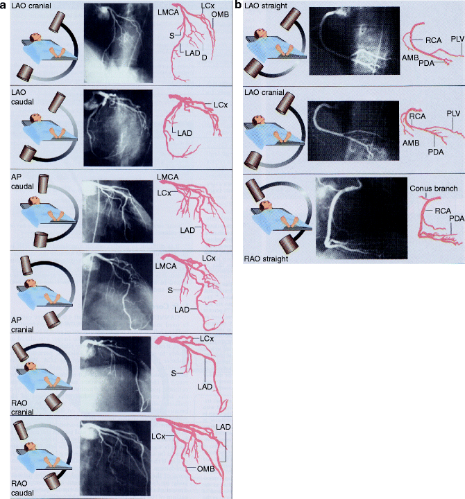 Invasive Coronary Angiography | SpringerLink