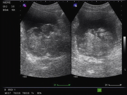 Management Of Postoperative Complications Following Turp Springerlink