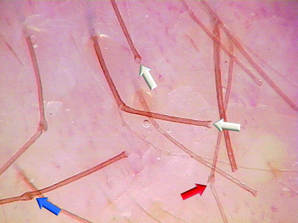 Trichorrhexis Invaginata and Netherton’s Syndrome | SpringerLink